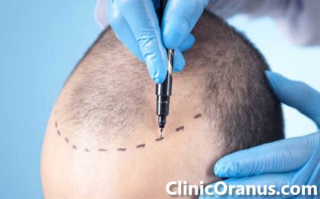 کاشت موی سر با تراکم بالا در کلینیک اورانوس