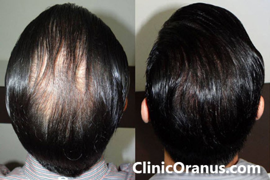 ویژگی های بهترین پزشک کاشت مو